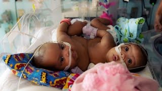 Conjoined twins separated after \