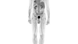 What is a PET scan?