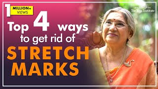 How to get rid of stretch marks | Dr. Hansaji Yogendra