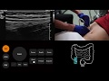 Ultrasound Tutorial: Appendix/Appendicitis | Radiology Nation