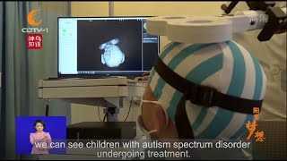 TMS Therapy in Autism Spectrum Disorder: Light up Hope for Numerous Children with ASD
