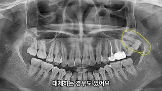 어금니에 충치있는데, 사랑니를 대신 쓸 수 있나요?