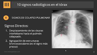 10 Signos Radiológicos en el Tórax