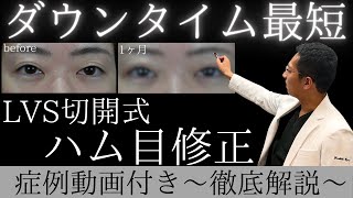 切るのにダウンタイムが最短！ハム目修正（睫毛上皮膚切除）の徹底解説：全切開二重の他院修正