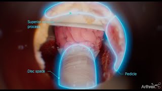 Thoracic Transforaminal Endoscopic Discectomy