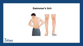 Swimmer's Itch