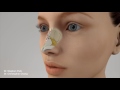 nasal hump removal nosejob