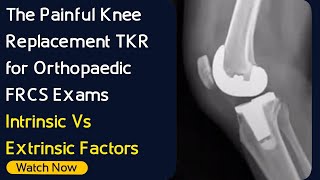 The painful Knee Replacement TKR for Orthopaedic Exams