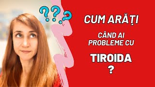 CUM ARĂȚI când ai probleme cu TIROIDA?