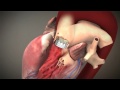 Transapical Animation (TAVR) | Doylestown Hospital