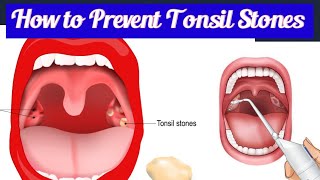 How to Prevent Tonsil Stones Naturally | Best Tips for Fresh Breath \u0026 Healthy Tonsils!