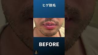 【ヒゲ脱毛】施術Ｂｅｆｏｒｅ→Ａｆｔｅｒ【ロミオワックス】