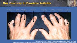 2015 Bone Immunology – Ankylosing Spondylitis and Psoriatic Arthritis