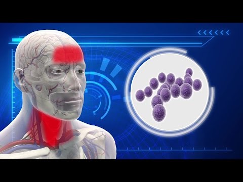 What is strep throat and how do you catch it? What is strep throat and how do you catch it?