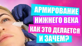 Армирование нижнего века нитями | Процесс выполнения процедуры косметологом