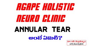 annular tear అంటే ఏమిటి