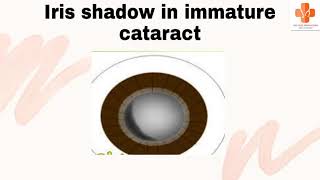 IRIS SHADOW TEST