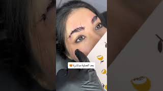 عمليه رفع الحاجب جراحيه شاهد قبل وبعد العمليه Eyebrow lift surgery شاهد تغير ونتيجه