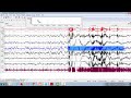 natus psg webinar case study scoring sleep stages u0026 limb movements