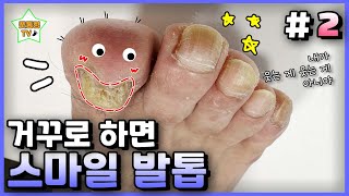 eng [2]발톱이 두꺼워져서 너무 아파요..｜레푸스 서면점/사상점/남포점｜내성발톱｜문제성발톱｜ingrown toenail｜Athlete's foot-Fresh Foot