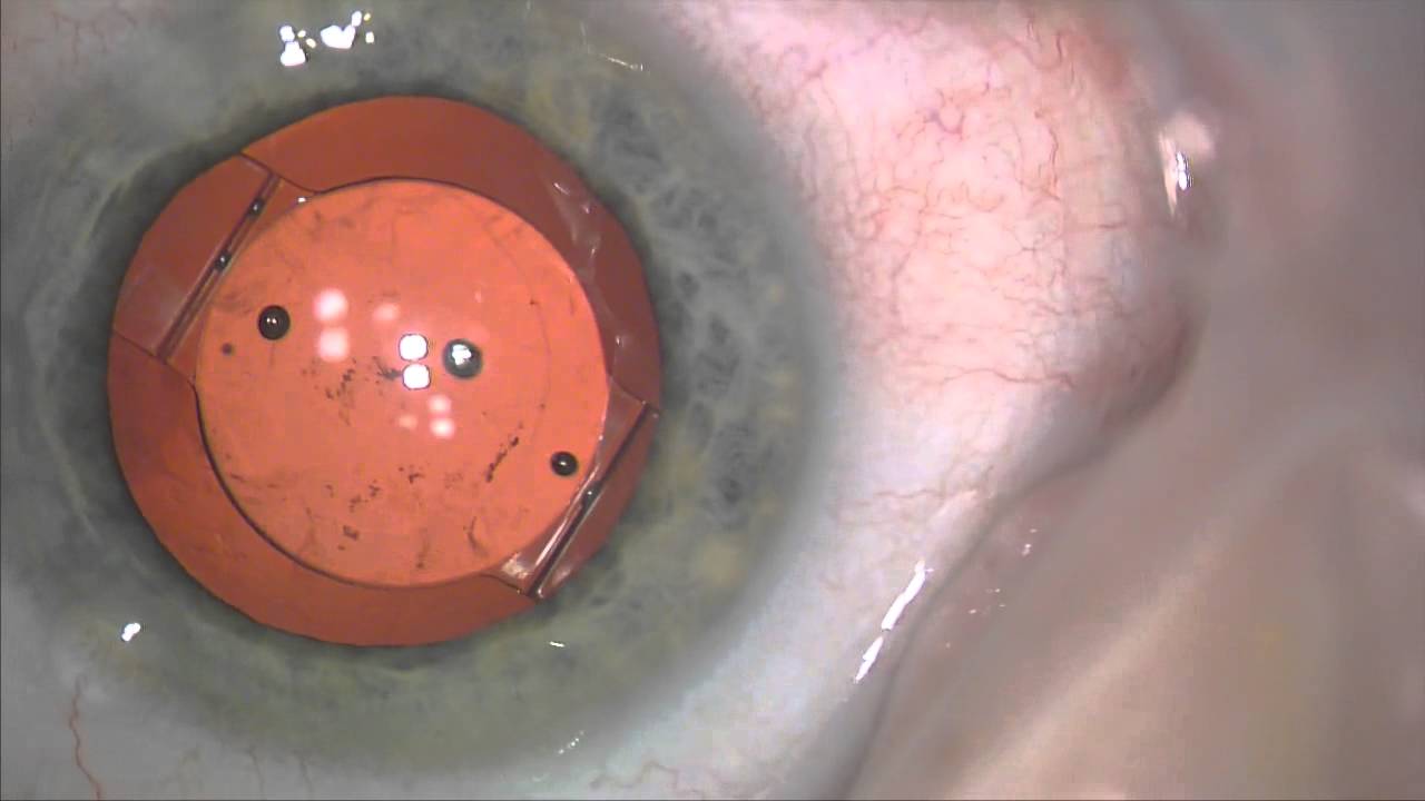 Dropless Cataract Surgery Using Triamcinolone, Moxifloxacin, And ...