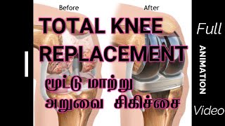 முழு மூட்டு மாற்று அறுவை சிகிச்சை - Total Knee joint replacement surgery - Full animation video