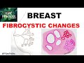 Diseases of Breast: Part 1. Normal anatomy, Classification & FIBROCYSTIC CHANGES