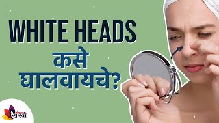 व्हाईट हेड्स कोणाला होऊ शकतात आणि त्यावरील उपाय | Home Remedy for white Heads | Lokmat Sakhi