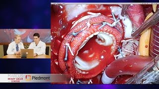 Rarely Seen Surgical Footage of Carcinoid Heart Disease