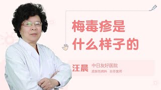 梅毒疹是什么样子的