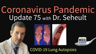 Coronavirus Pandemic Update 75: COVID-19 Lung Autopsies - New Data