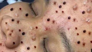 Relax squeezing out blackheads and whiteheads | 14 #blackheads #relax #acne