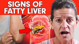 Fatty Liver Symptoms | Can Fasting Help REVERSE Fatty Liver | Dr. Mindy Pelz