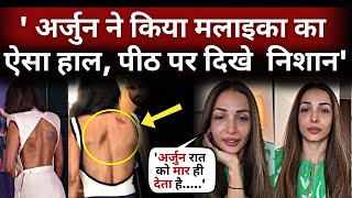 malaika arora khan love bite - Arjun Kapoor did Malaika Arora Such a condition,mark seen on the back