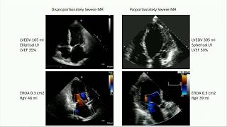 CVI 2019_Thursday 7/18_ Breaking Boundaries with Mitral Valve Therapy_Michael Mack, MD