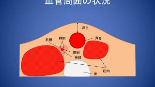 エコーガイド下穿刺動画マニュアル　④エコー下穿刺における各種穿刺法の使い分け（第一法と第二法）（実技：看護師　平山遼一、撮影・編集：IT推進部　花田真一、解説・監修：院長　下池英明）