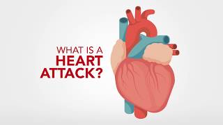 How Heart Attack Signs Differ in Men & Women- Health Plus Animated