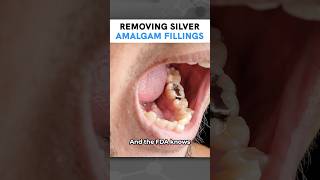 Removing Silver Amalgam Fillings