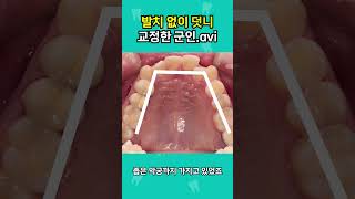 발치 없이 덧니 교정한 군인