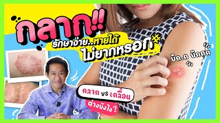 กลาก รักษาไม่ยากหากรักษาอย่างถูกวิธีและตรงจุด สามารถหยุดโรค หยุดเชื้อได้แน่นอน