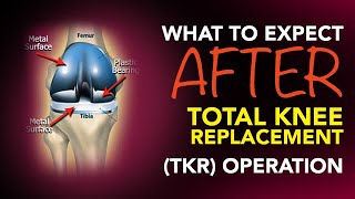 What To Expect After A Total Knee Replacement (TKR) Operation