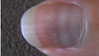 BE CAREFUL ABOUT THESE NAILS- Mees Lines