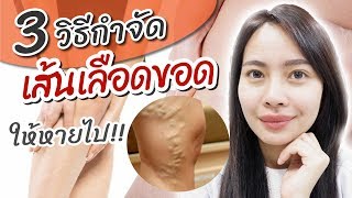 3 วิธีกำจัดเส้นเลือดขอด ให้หายไป!! โดยเภสัชกร | เภสัชท่องโลก 🌏#69