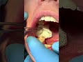 extraction of the 8th tooth or