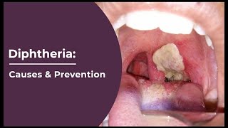 What Is Diphtheria | Causes, Symptoms And Prevention of Diphtheria