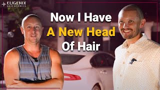 Hair Transplant Of Brothers Duo Of California| Is Hair Restoration Really Effective?