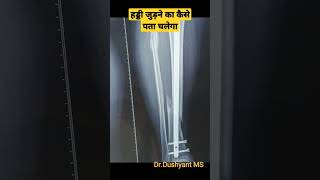 पैर Tibia की हड्डी कैसे जुड़ती है |  Leg Bone Fracture Union ✓✓ |