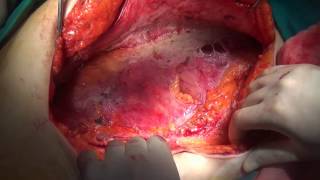 Cytoreductive surgery and HIPEC for peritoneal carcinomatosis