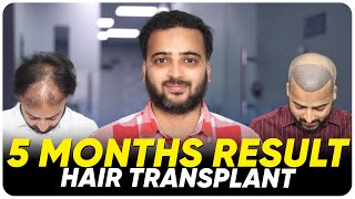 Hair Transplant in Dubai | Best Results \u0026 Cost of Hair Transplant in Dubai