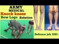 Army Medical Rejection? knock knees or bow legs